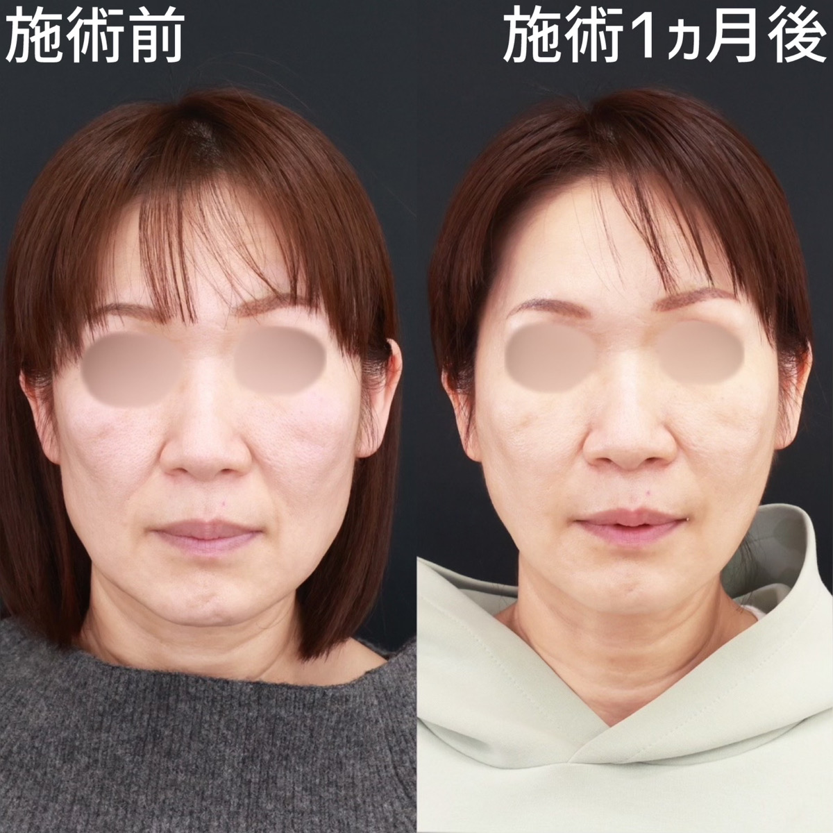 【糸リフト極】リフトアップで劇的若返り！