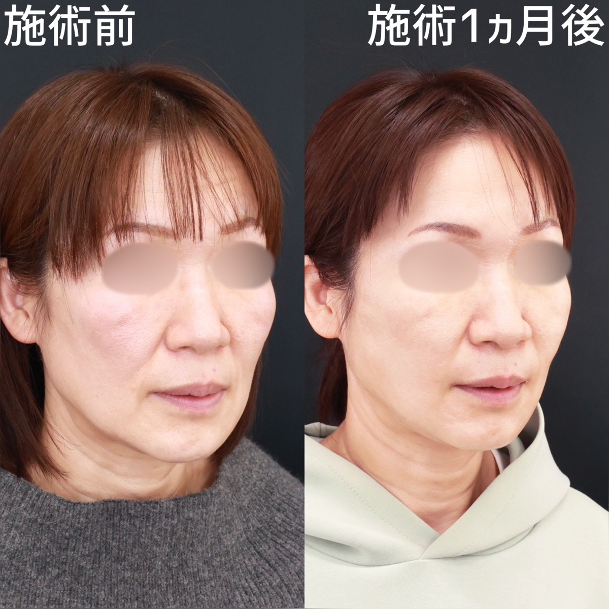 エラボトックス注射/TAC式 ツヤ肌コラーゲンリフト®/ほうれい線のヒアルロン酸注射の症例写真 施術前後 