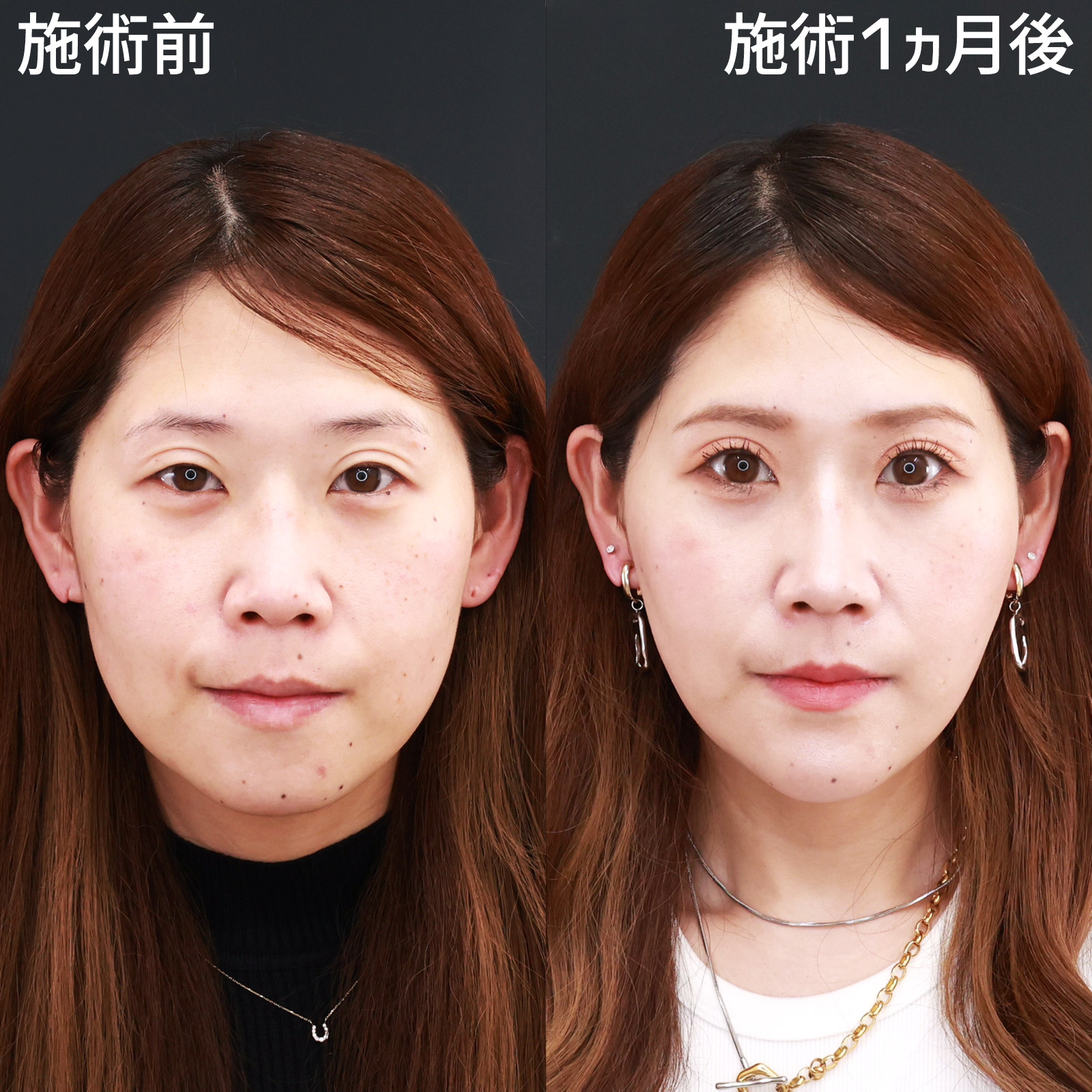 小顔整形｜パーフェクトフェイスライン/TAC式 ツヤ肌コラーゲンリフト®/ジョールファット除去の症例写真 施術前後 