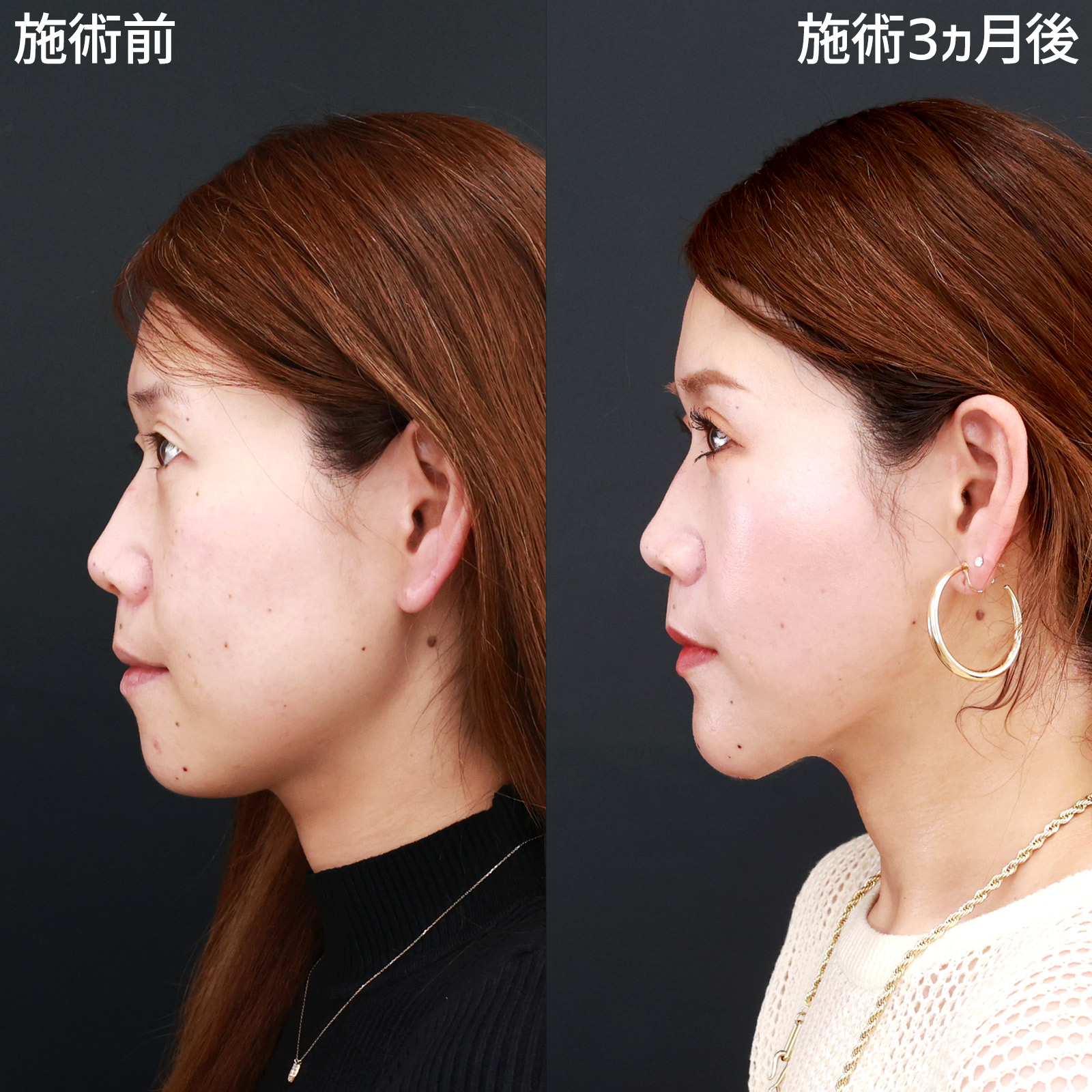 小顔整形｜パーフェクトフェイスライン/TAC式 ツヤ肌コラーゲンリフト®/ジョールファット除去の症例写真 施術前後 