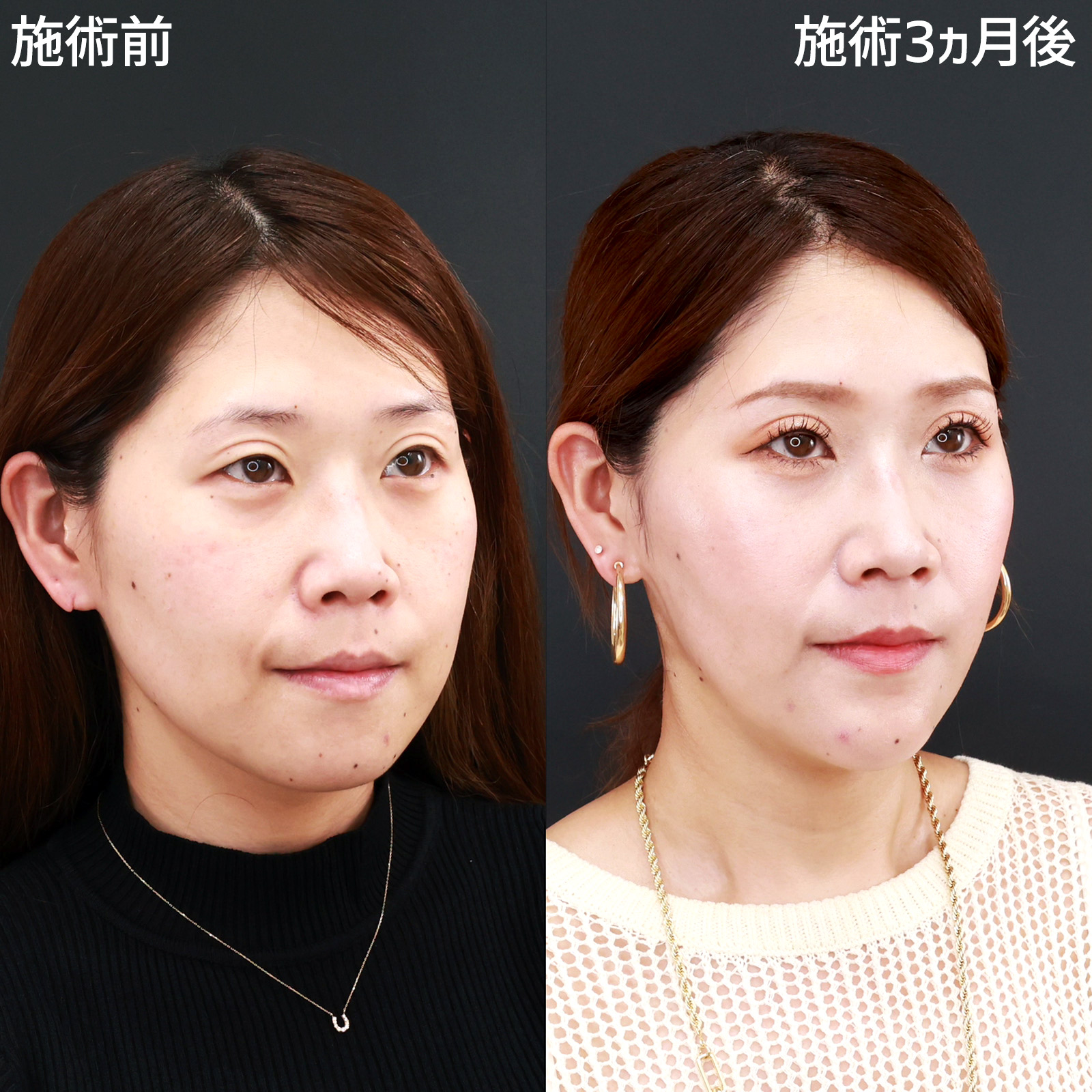 小顔整形｜パーフェクトフェイスライン/TAC式 ツヤ肌コラーゲンリフト®/ジョールファット除去の症例写真 施術前後 