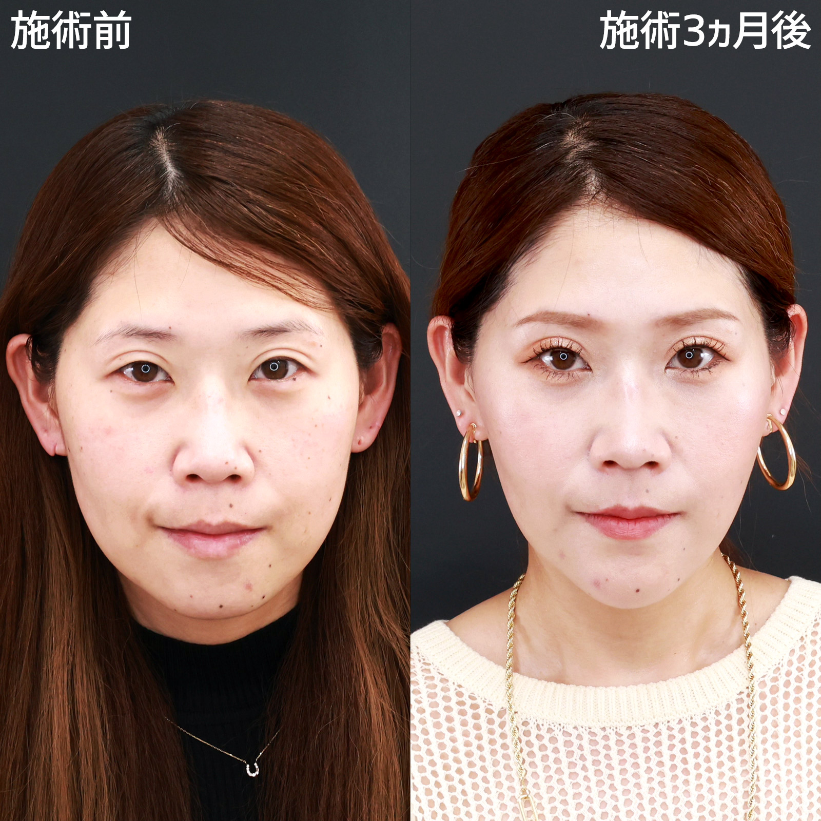 【パーフェクトフェイスライン】小顔複合施術でアンチエイジング！丸い輪郭がVラインに大変身！