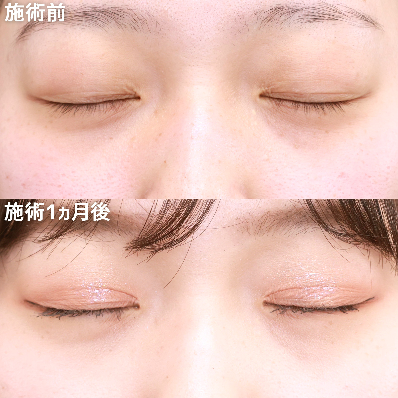 クイックコスメリングの症例写真 施術前後 
