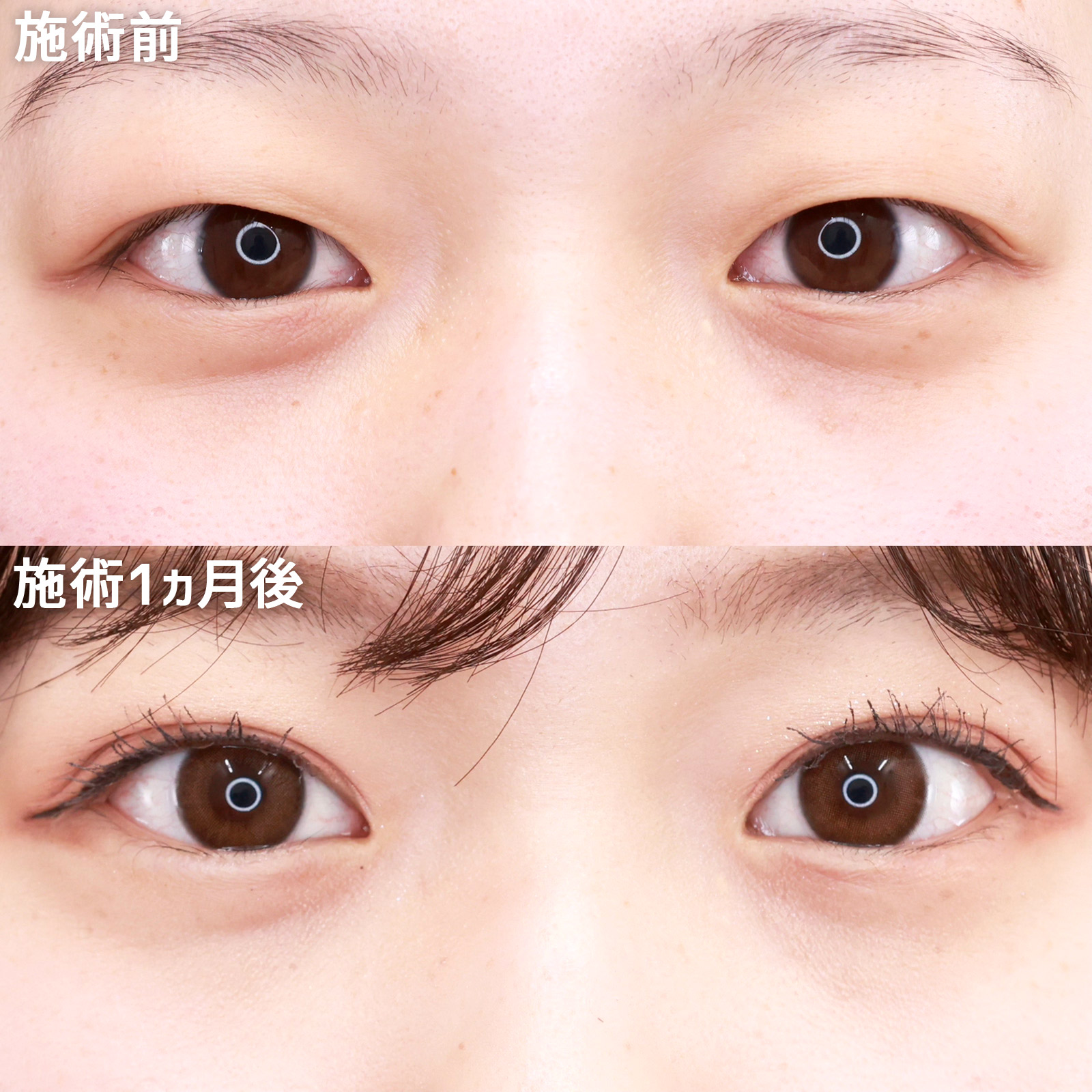 【バレにくい二重整形】厚いまぶたでも大丈夫！埋没法で理想の二重に