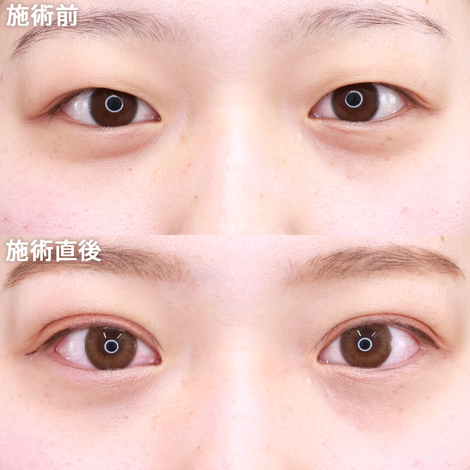 クイックコスメリングの症例写真 施術前後 