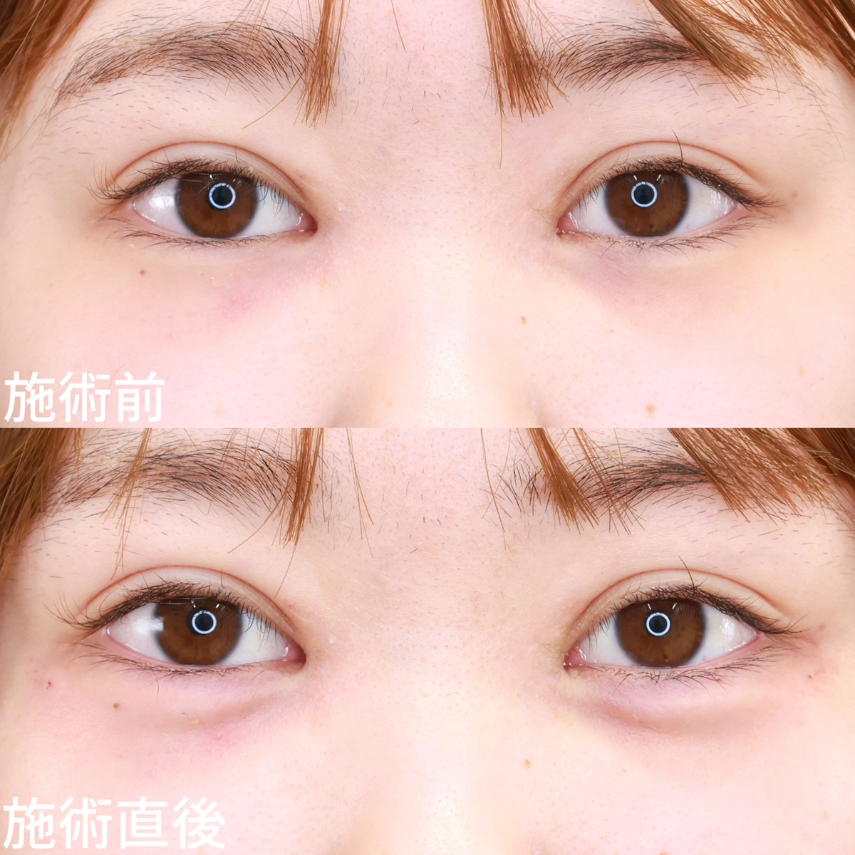 【涙袋ヒアルロン酸注射】ぷっくり可愛いお目元に！