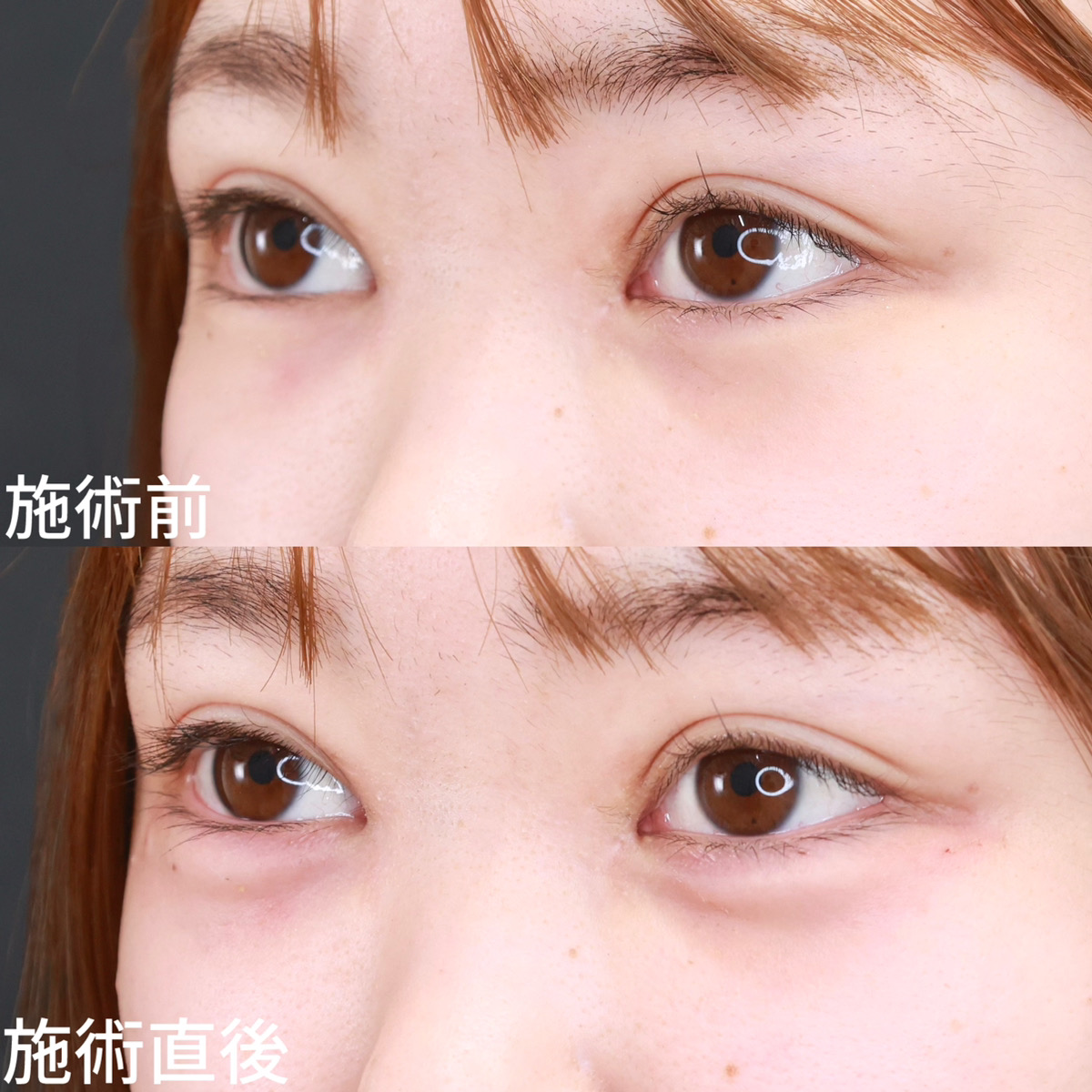 涙袋形成（ヒアルロン酸注射）の症例写真 施術前後 