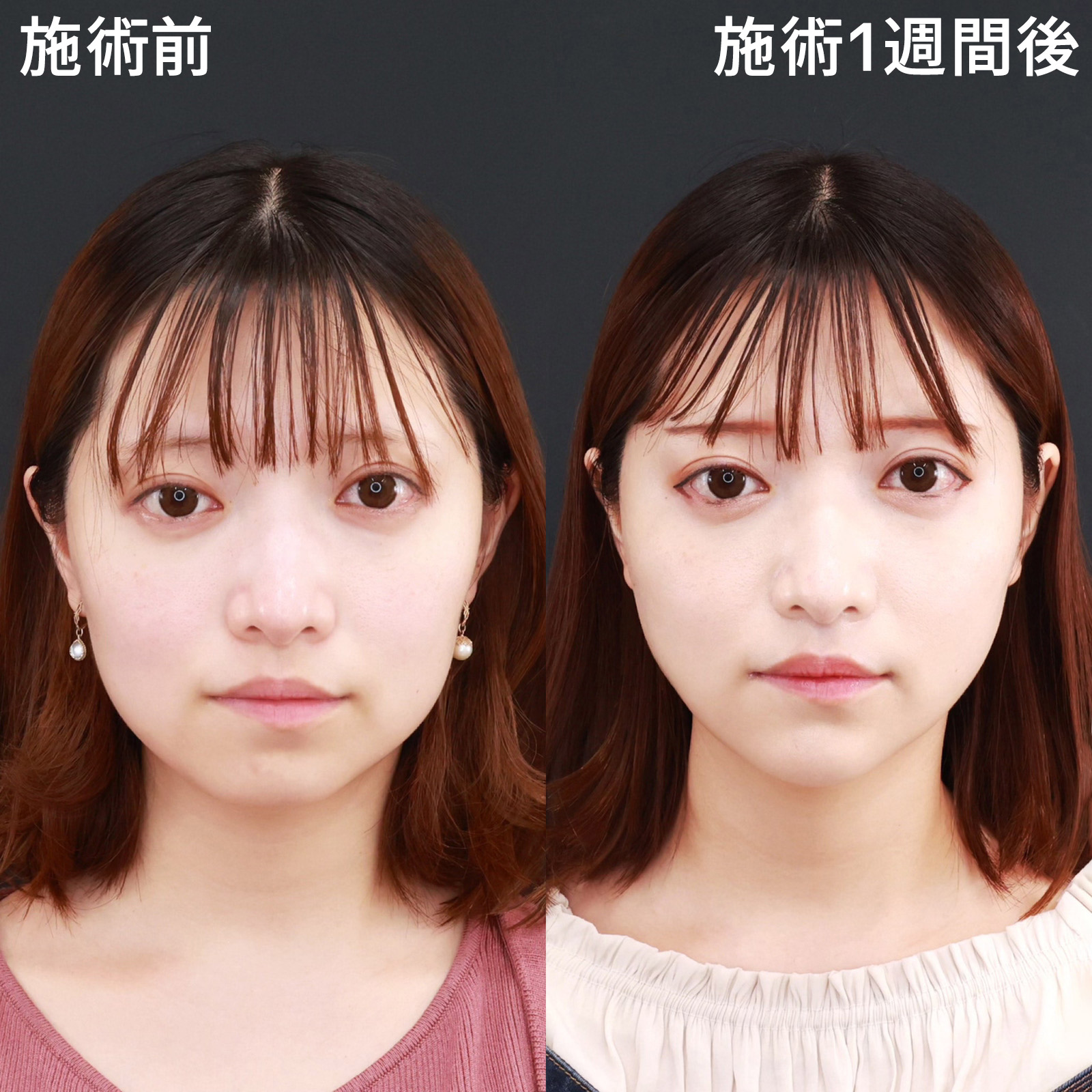 【糸リフト極】たった1週間でもたつきを解消！スッキリとした小顔に大変身