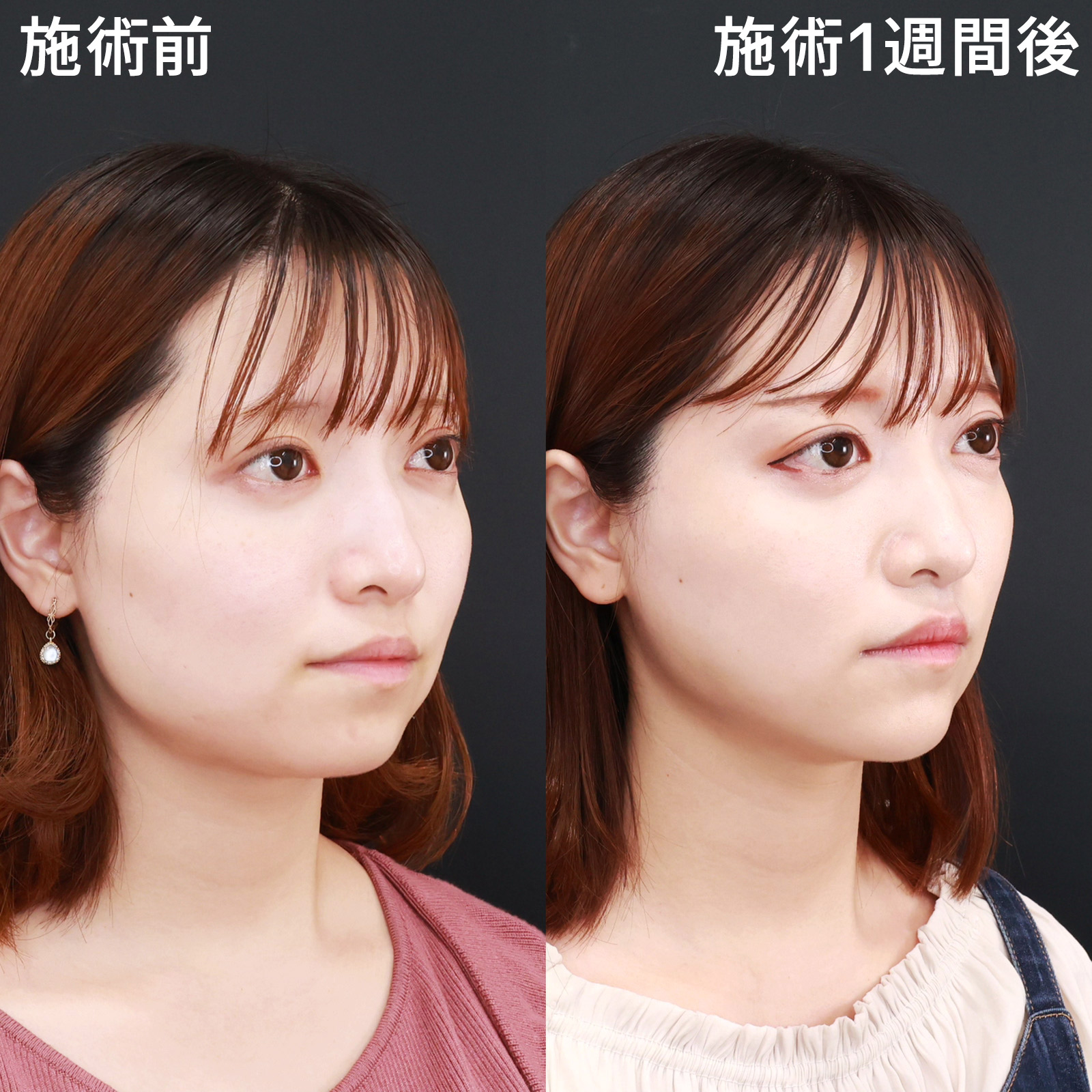 ジョールファット除去/TAC式 ツヤ肌コラーゲンリフト®/顎のヒアルロン酸注射の症例写真 施術前後 