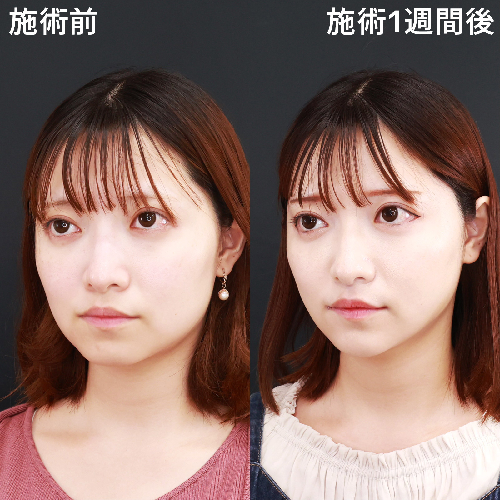 ジョールファット除去/TAC式 ツヤ肌コラーゲンリフト®/顎のヒアルロン酸注射の症例写真 施術前後 