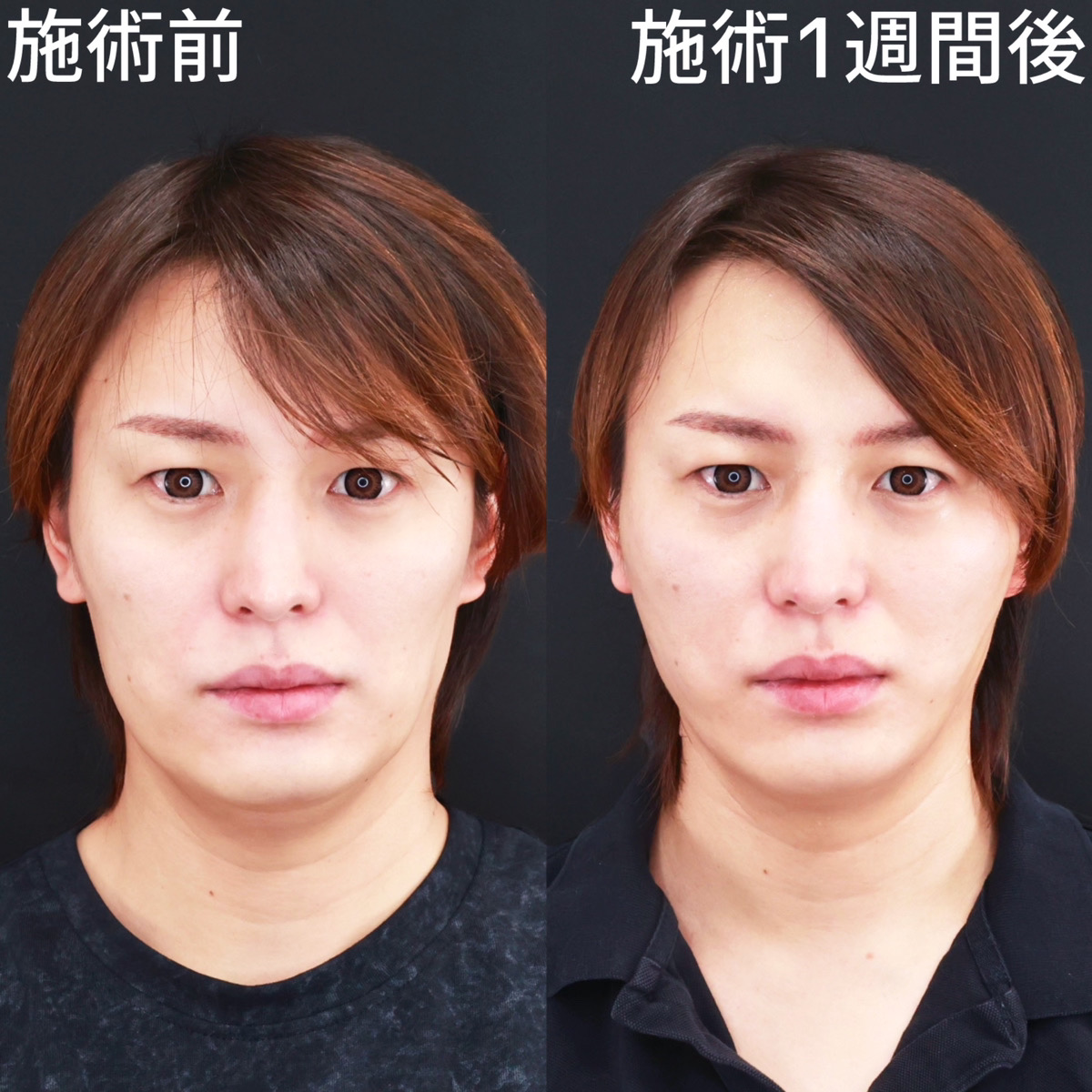 【糸リフト極】たるみを引き上げ、面長を解消！