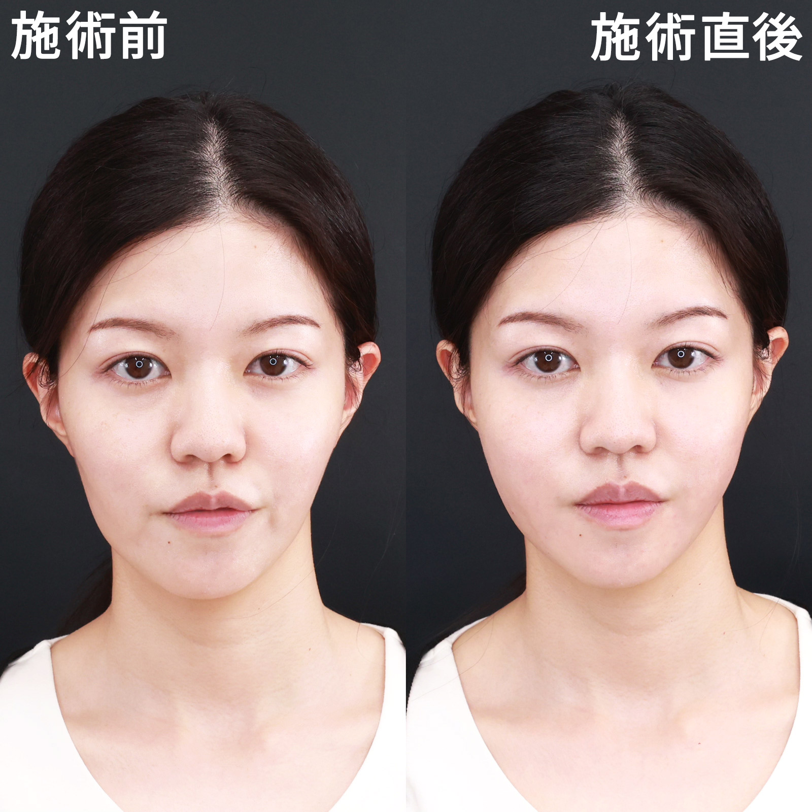 【ヒアルロン酸注入】たった数分で見た目年齢マイナス5歳！ダウンタイムの少ないアンチエイジング治療