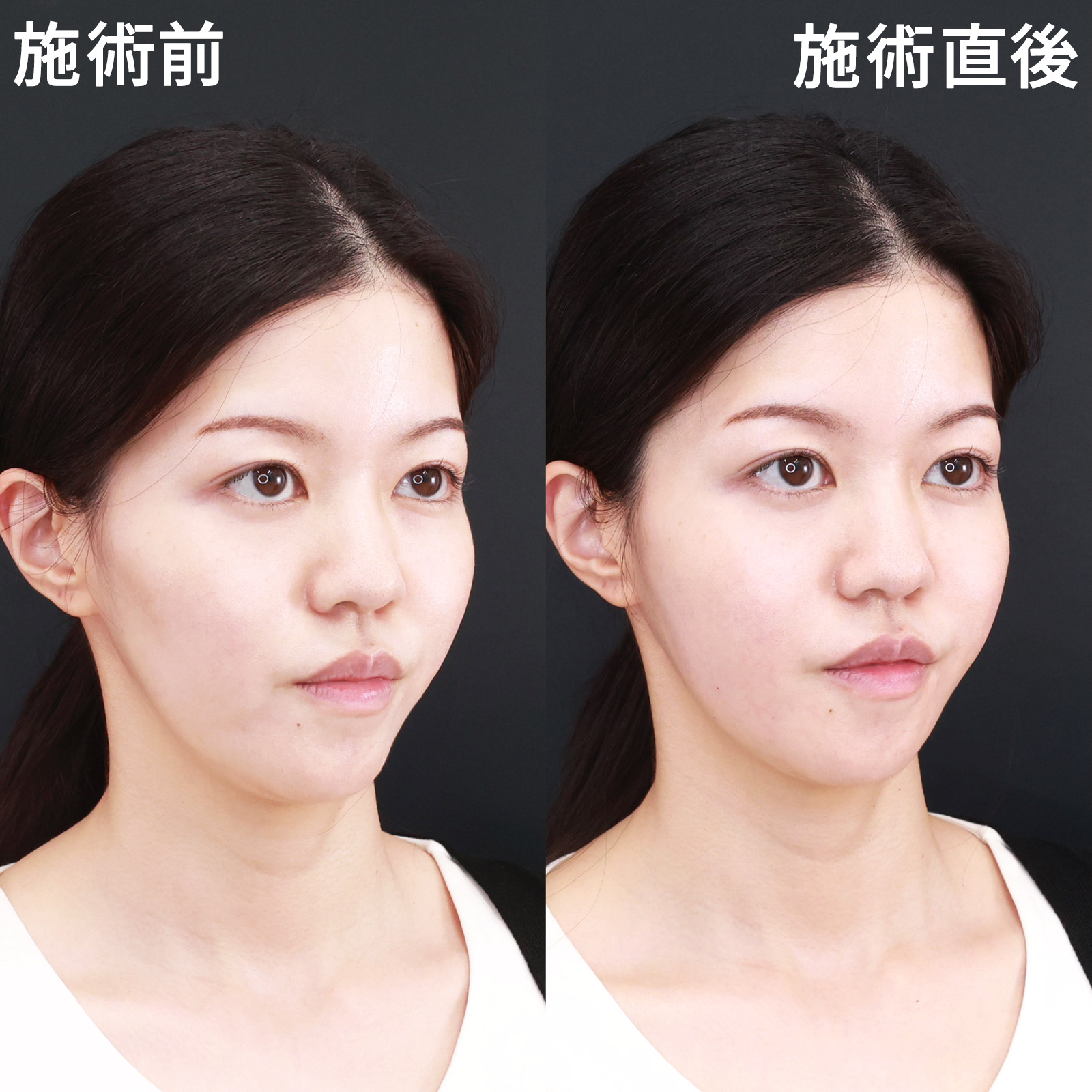 マリオネットラインのヒアルロン酸注射/ヒアルロン酸注射：その他の症例写真 施術前後 