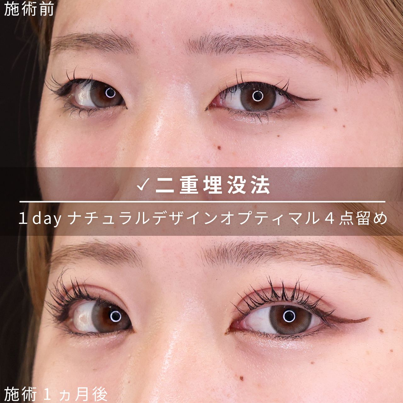 二重埋没法の症例写真 施術前後 