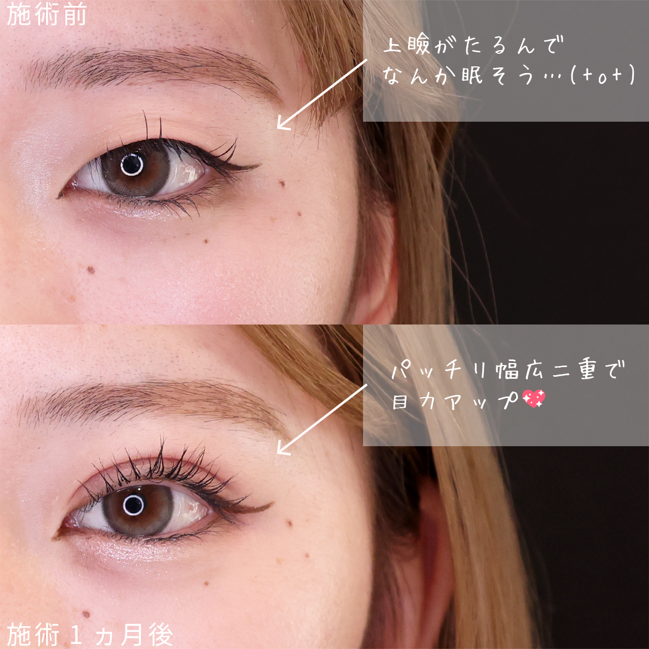 二重埋没法の症例写真 施術前後 