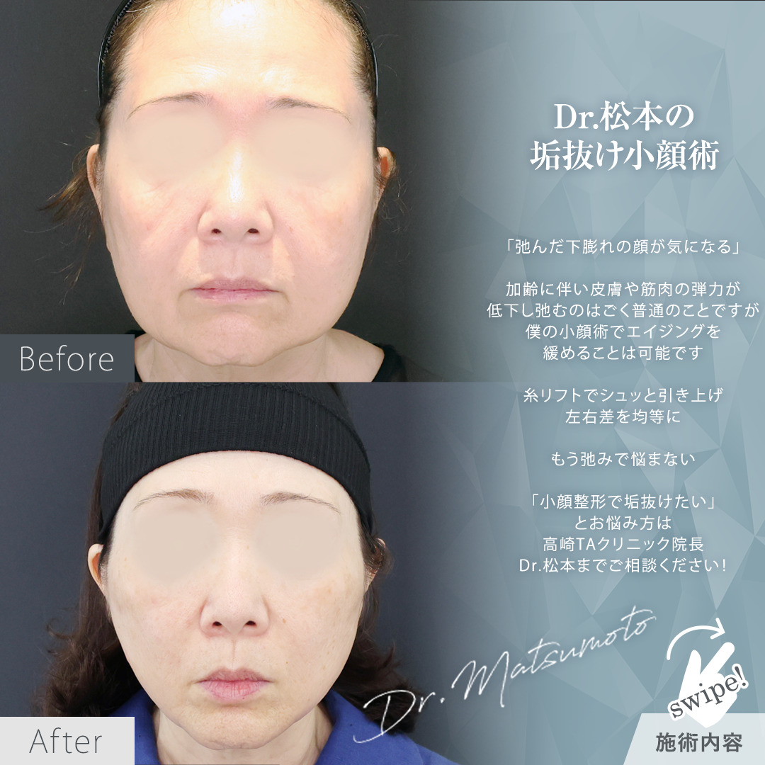 TAC式 ツヤ肌コラーゲンリフト®の症例写真 施術前後 