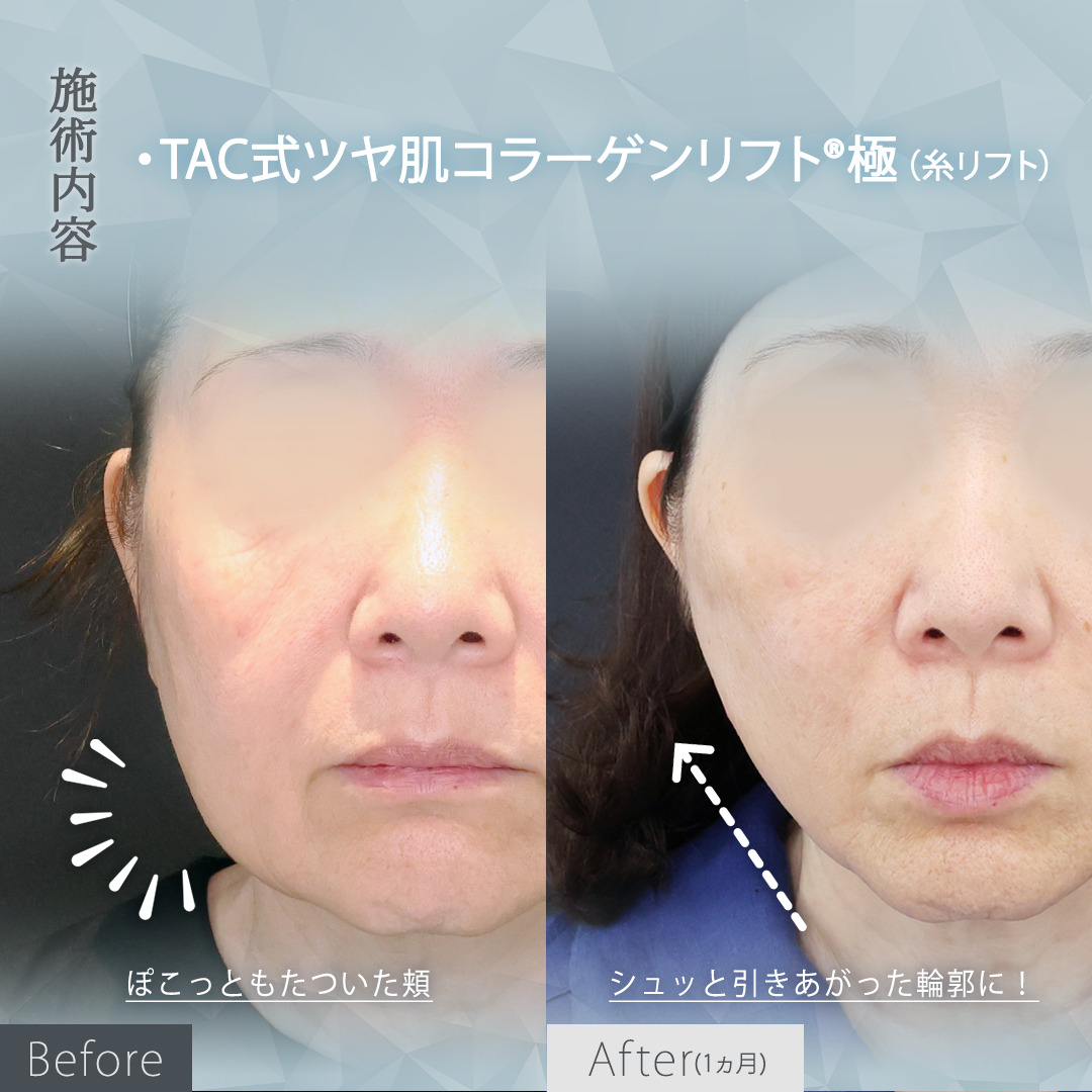 TAC式 ツヤ肌コラーゲンリフト®の症例写真 施術前後 