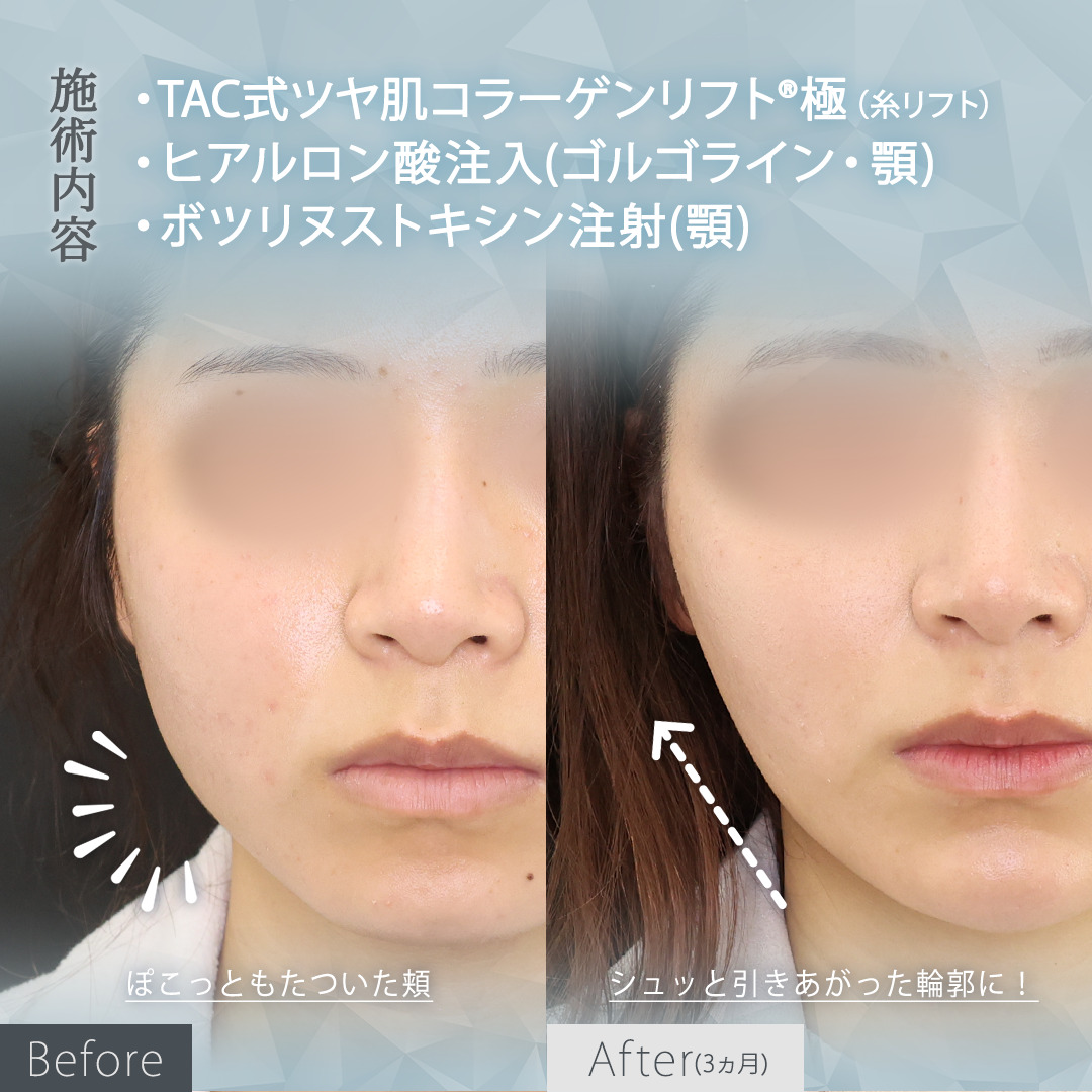 TAC式 ツヤ肌コラーゲンリフト®/バッカルファット除去/顎のヒアルロン酸注射の症例写真 施術前後 