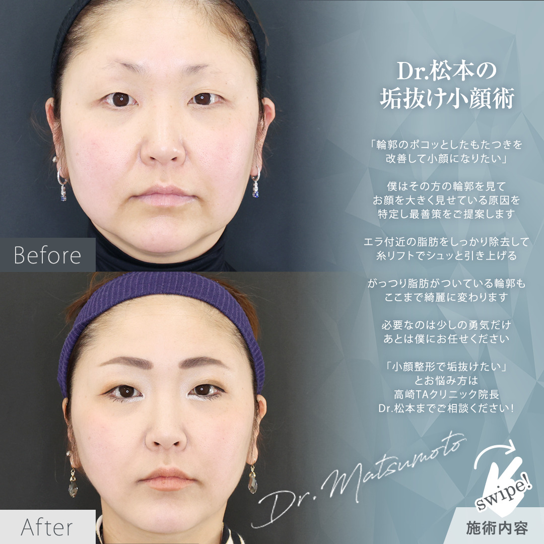 TAC式 ツヤ肌コラーゲンリフト®/Lラインファット除去（エラ下脂肪除去）/ボトックス注射：その他の症例写真 施術前後 