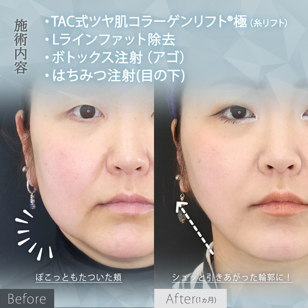 TAC式 ツヤ肌コラーゲンリフト®/Lラインファット除去（エラ下脂肪除去）/ボトックス注射：その他の症例写真 施術前後 