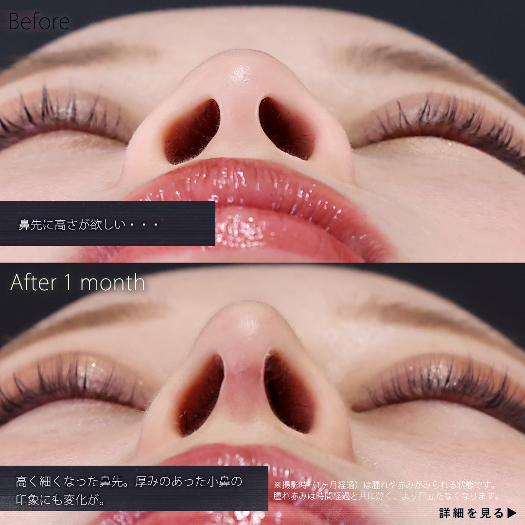 鼻中隔延長術/鼻先軟骨移植/鼻尖形成・鼻尖縮小の症例写真 施術前後 
