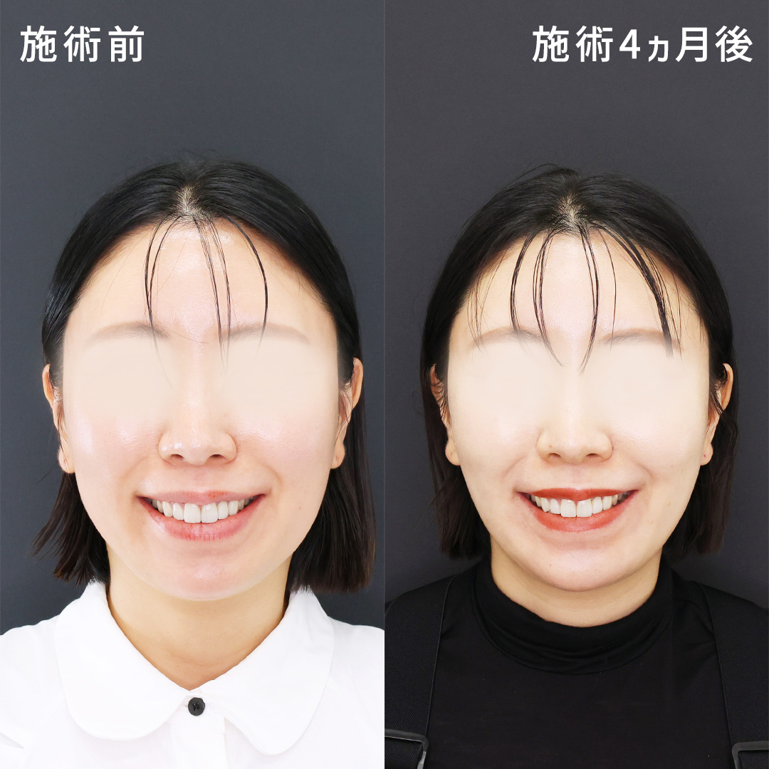 笑顔アップデート【脂肪除去のみのナチュラルな垢抜け】