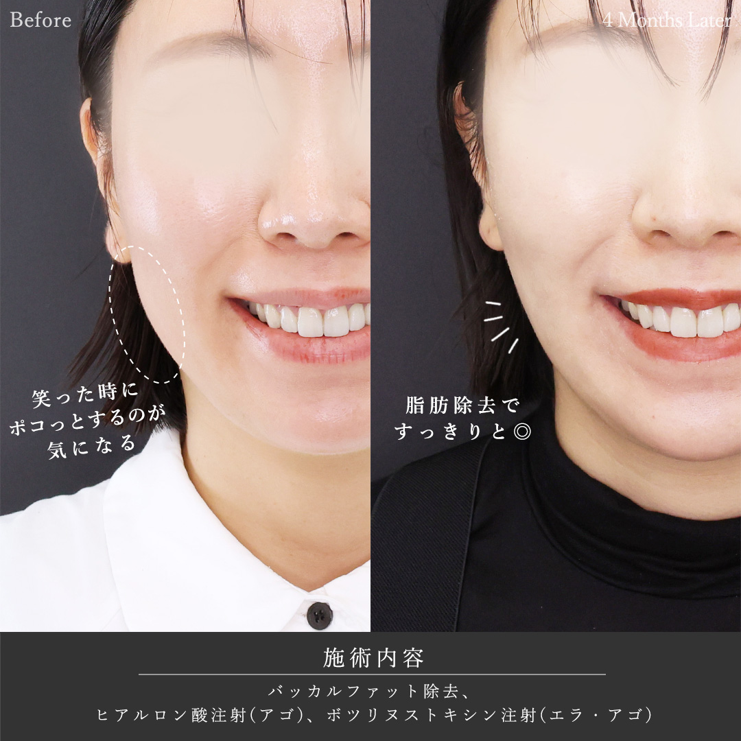 バッカルファット除去/顎のヒアルロン酸注射/エラボトックス注射の症例写真 施術前後 