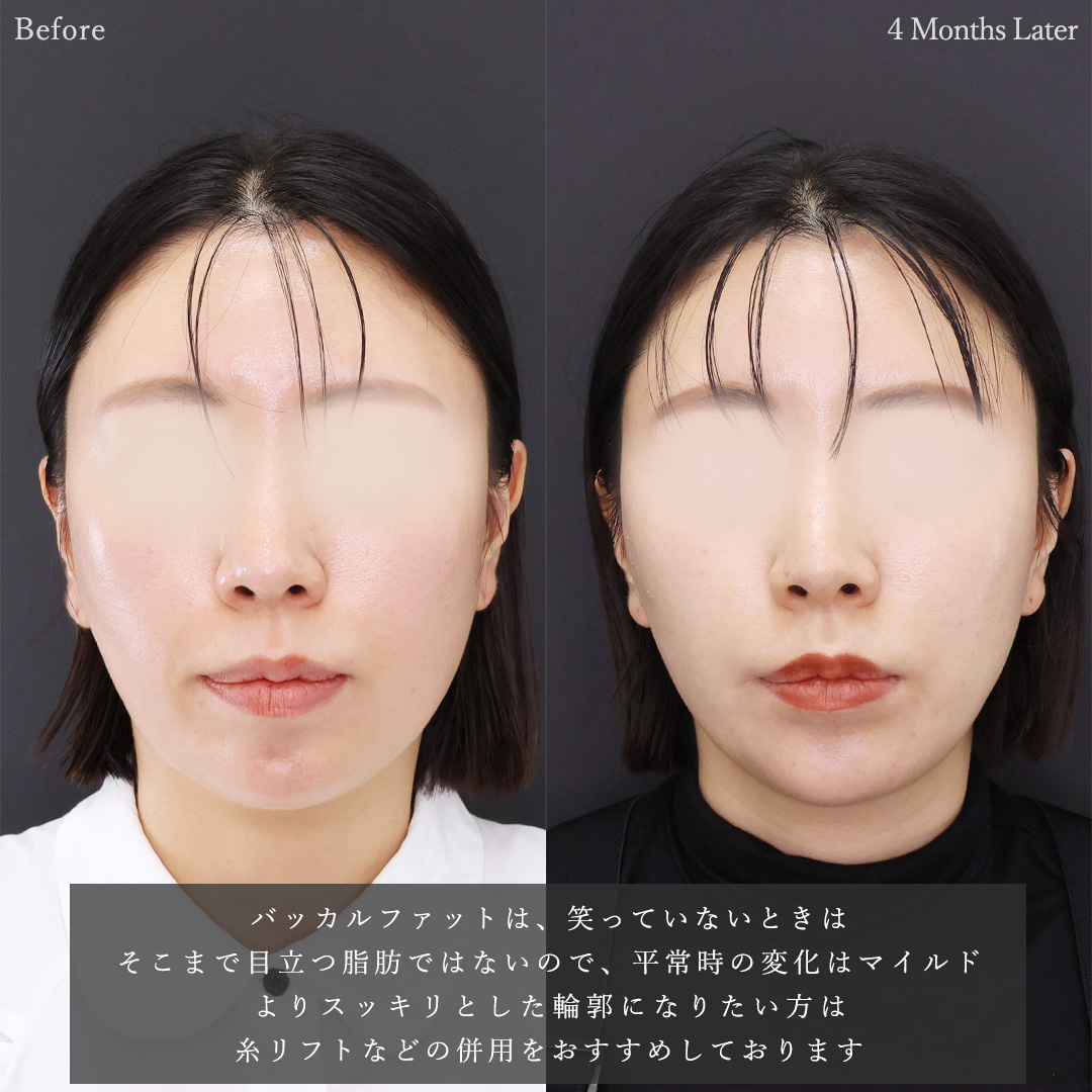 バッカルファット除去/顎のヒアルロン酸注射/エラボトックス注射の症例写真 施術前後 