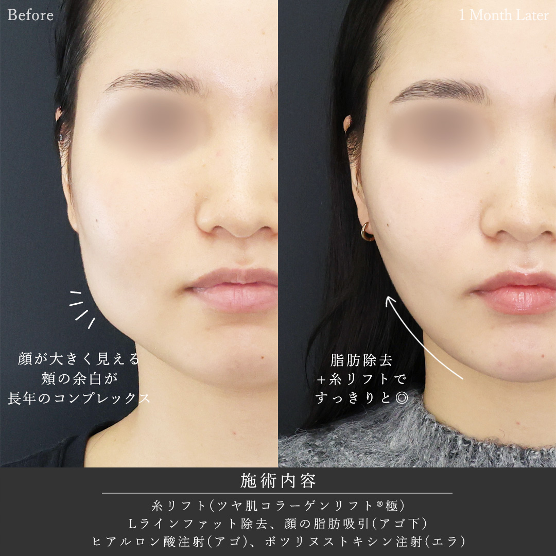TAC式 ツヤ肌コラーゲンリフト®/Lラインファット除去（エラ下脂肪除去）/顔の脂肪吸引の症例写真 施術前後 