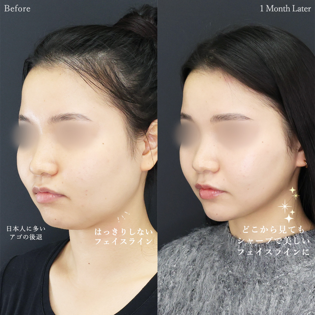 TAC式 ツヤ肌コラーゲンリフト®/Lラインファット除去（エラ下脂肪除去）/顔の脂肪吸引の症例写真 施術前後 
