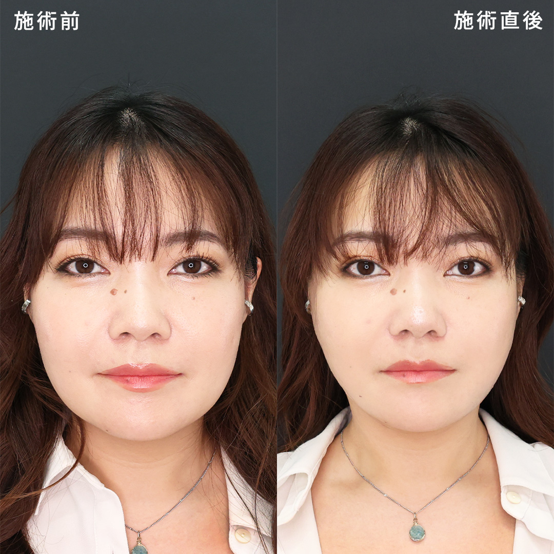 【直後の変化に注目】Dr.香山の小顔術｜パーフェクトフェイスライン