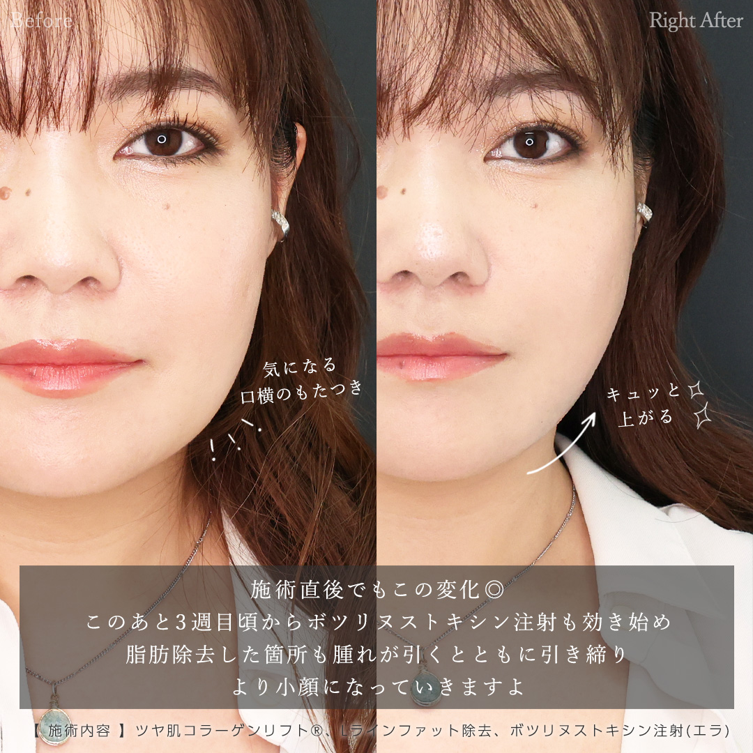 TAC式 ツヤ肌コラーゲンリフト®/Lラインファット除去(エラ下脂肪除去)/エラボトックス注射の症例写真 施術前後
