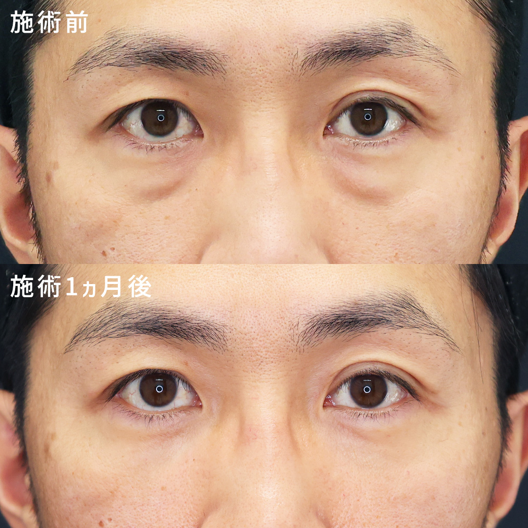 【目の下のクマ取り】40代男性もクマ取りで若々しい印象に◎