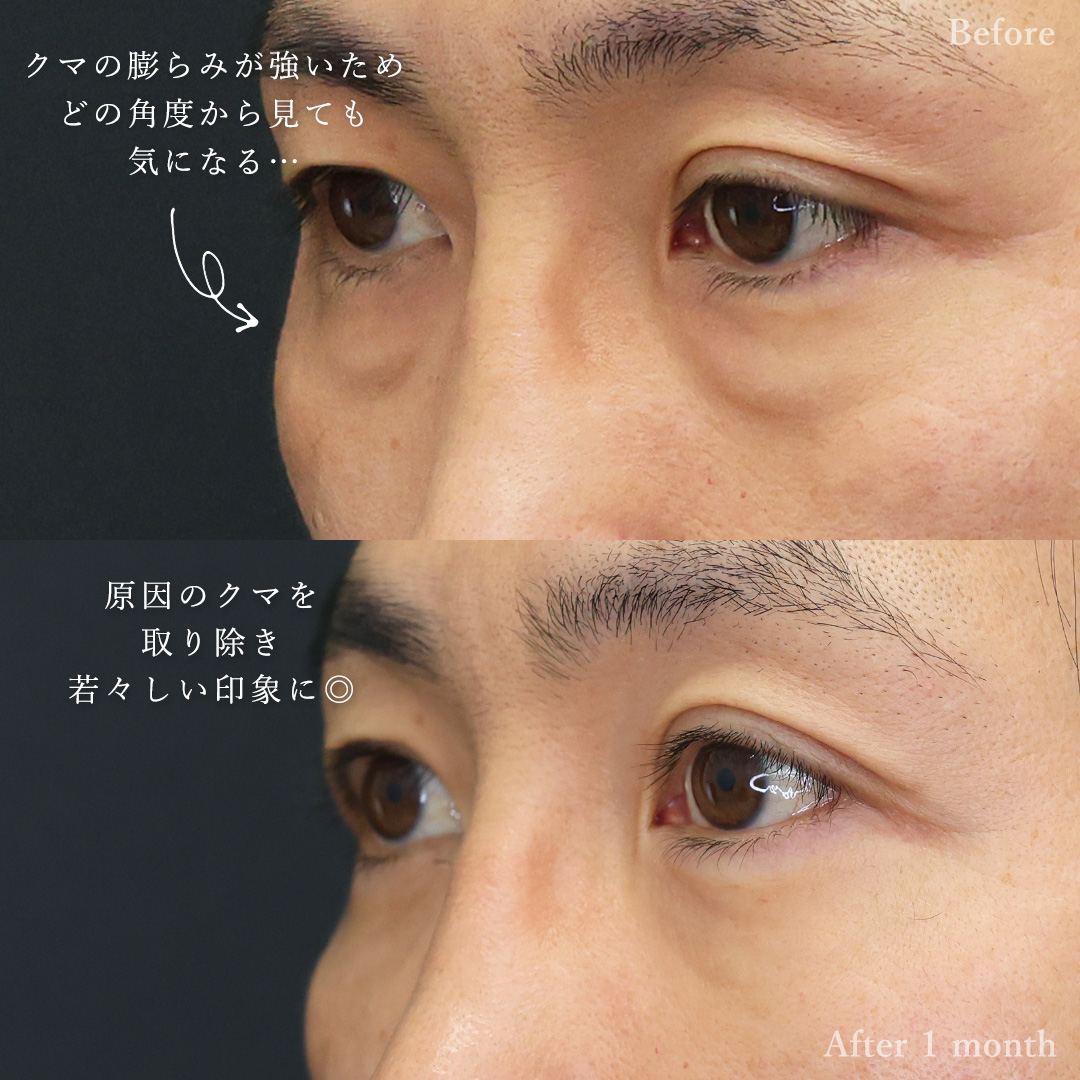 下眼瞼脱脂術（目の下のたるみ取り・目の下の脂肪ふくらみ取り）の症例写真 施術前後 
