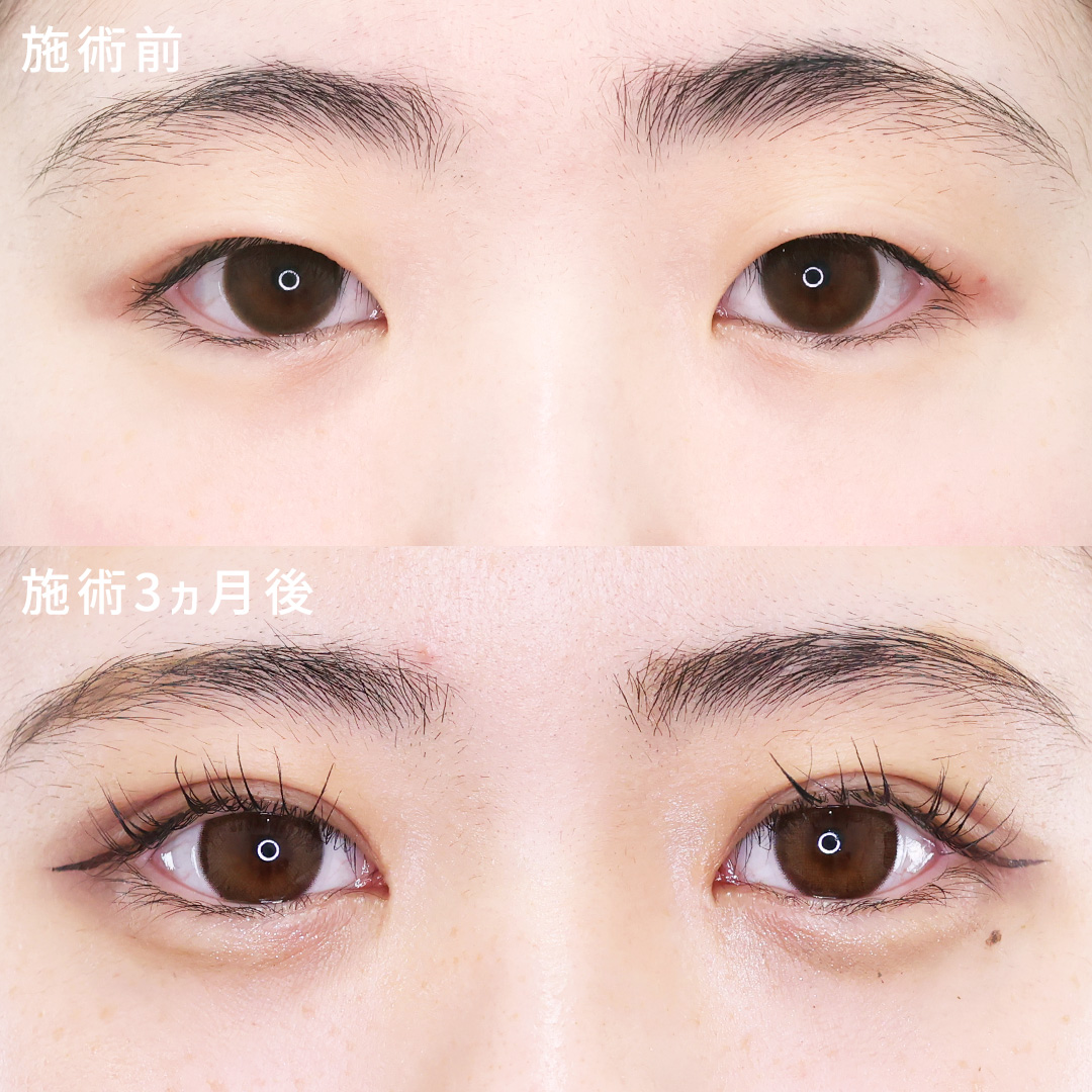 目頭切開+二重埋没で憧れの「Mix型二重」に