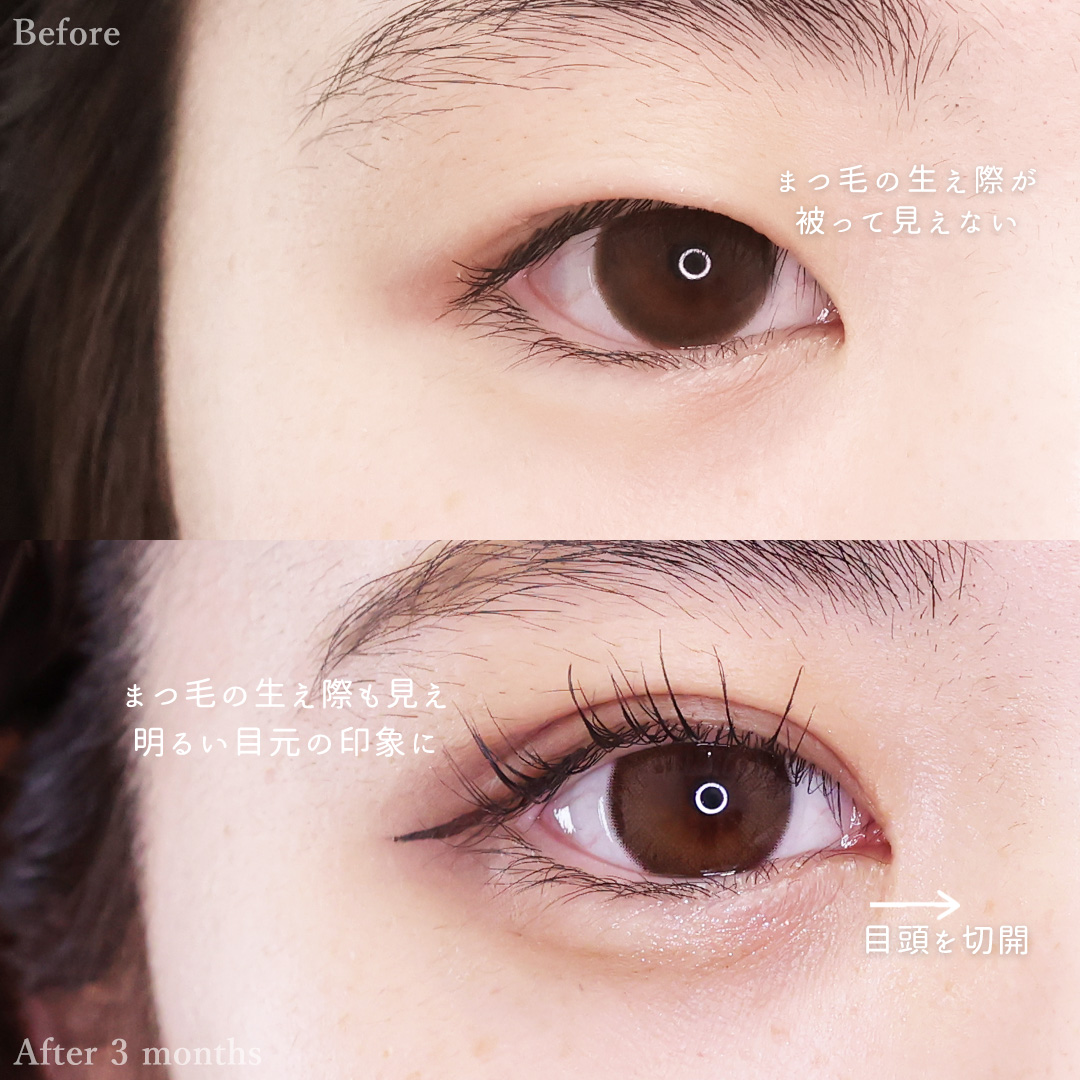 目頭切開術/二重埋没法の症例写真 施術前後 