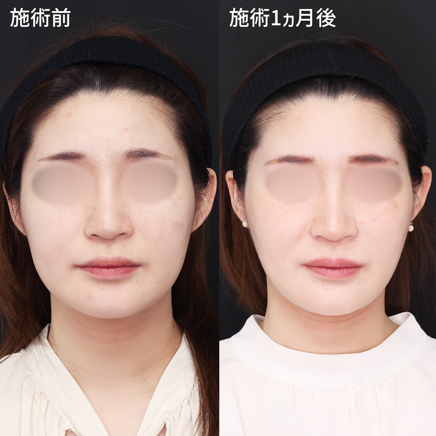 脂肪を取らない小顔術