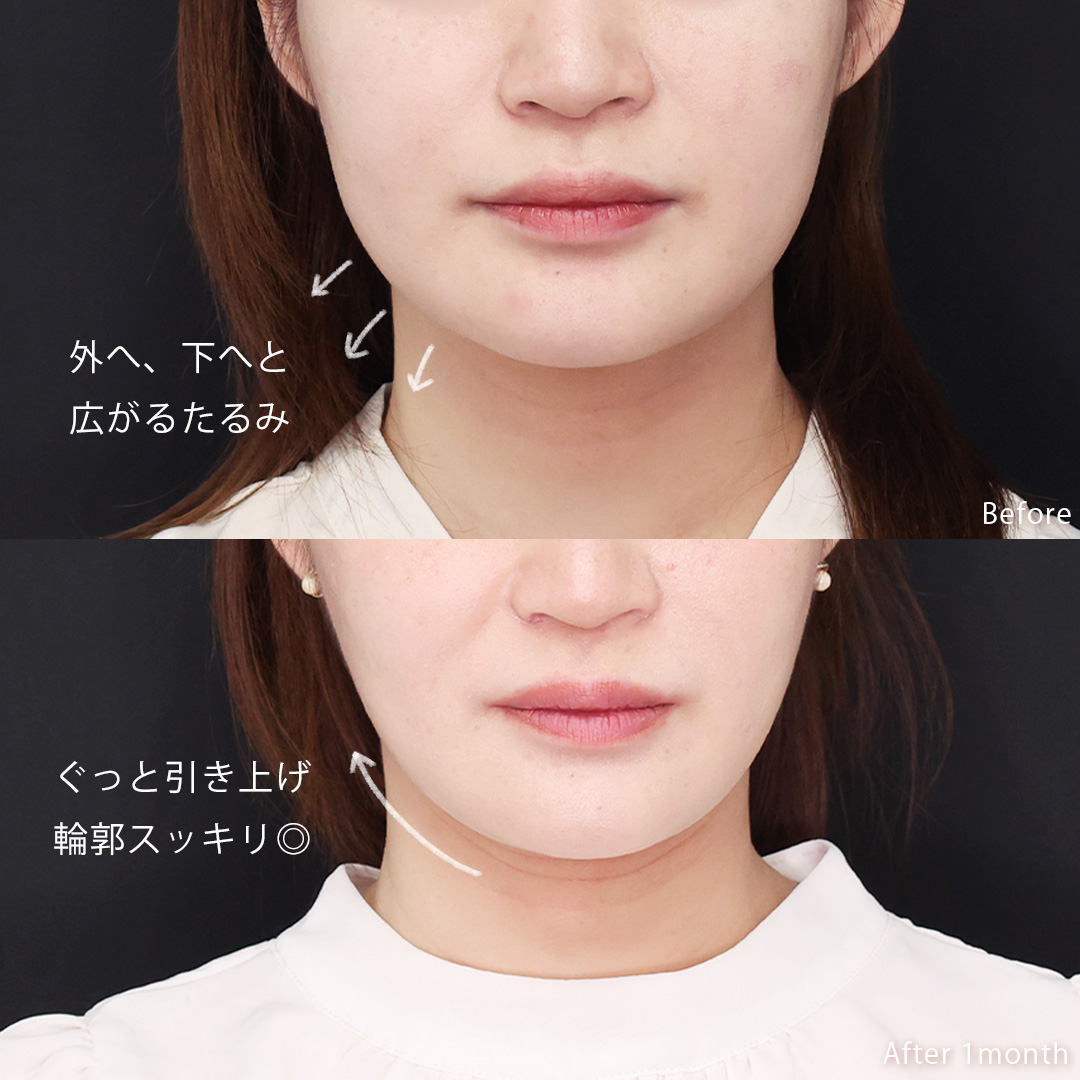 TAC式 ツヤ肌コラーゲンリフト®/ヒアルロン酸注射：その他の症例写真 施術前後 