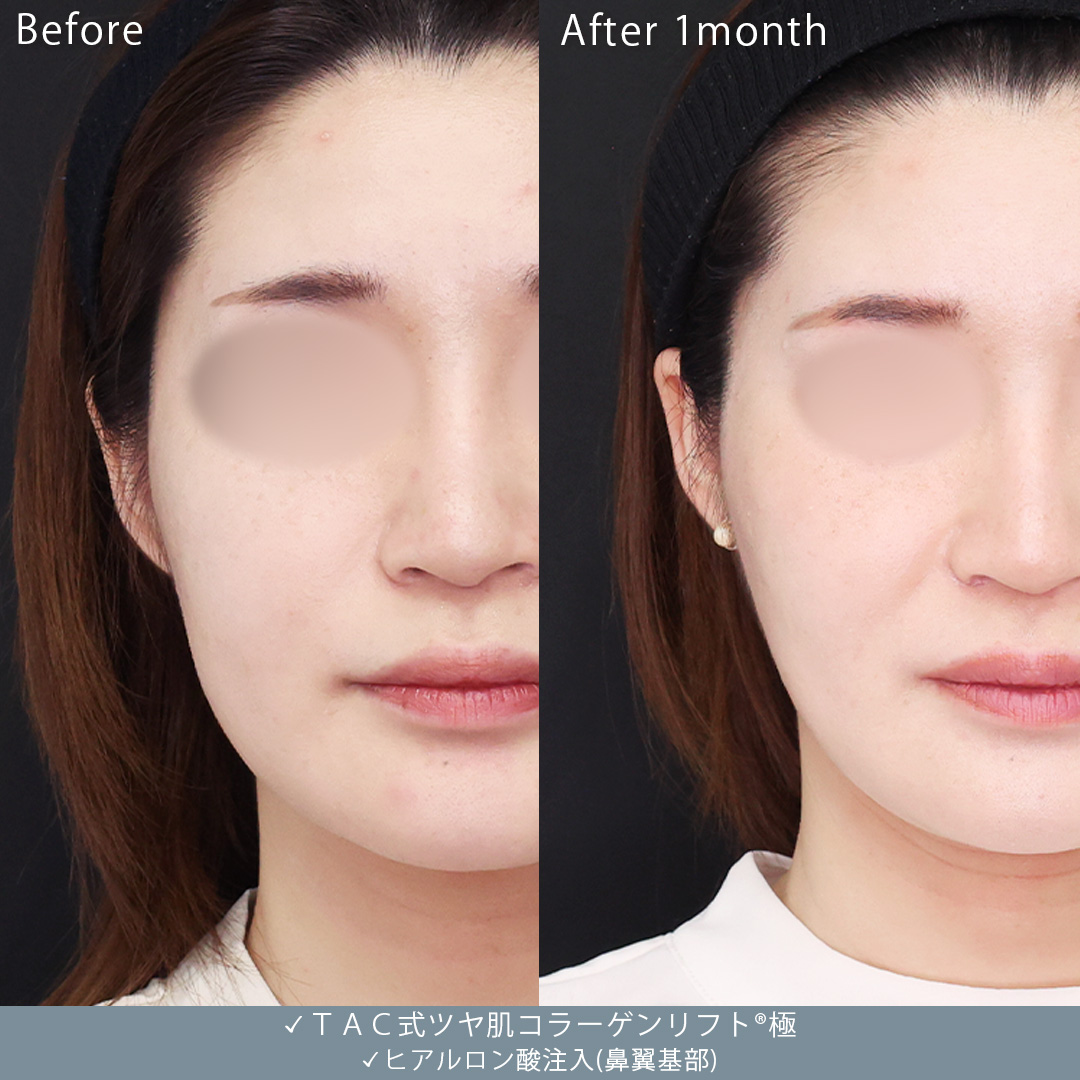 TAC式 ツヤ肌コラーゲンリフト®/ヒアルロン酸注射：その他の症例写真 施術前後 