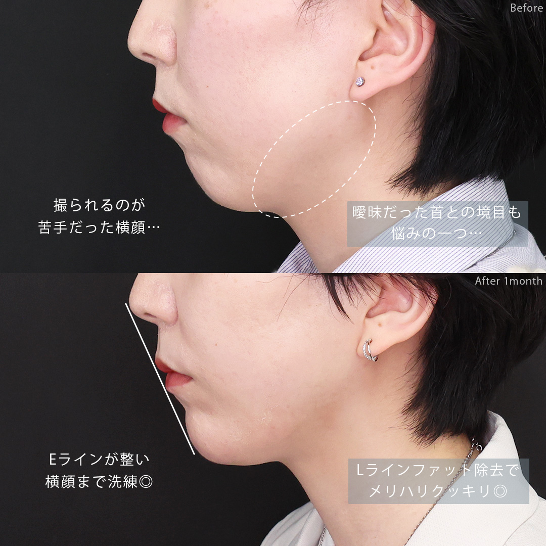 小顔整形｜パーフェクトフェイスライン/TAC式 ツヤ肌コラーゲンリフト®/Lラインファット除去（エラ下脂肪除去）の症例写真 施術前後 