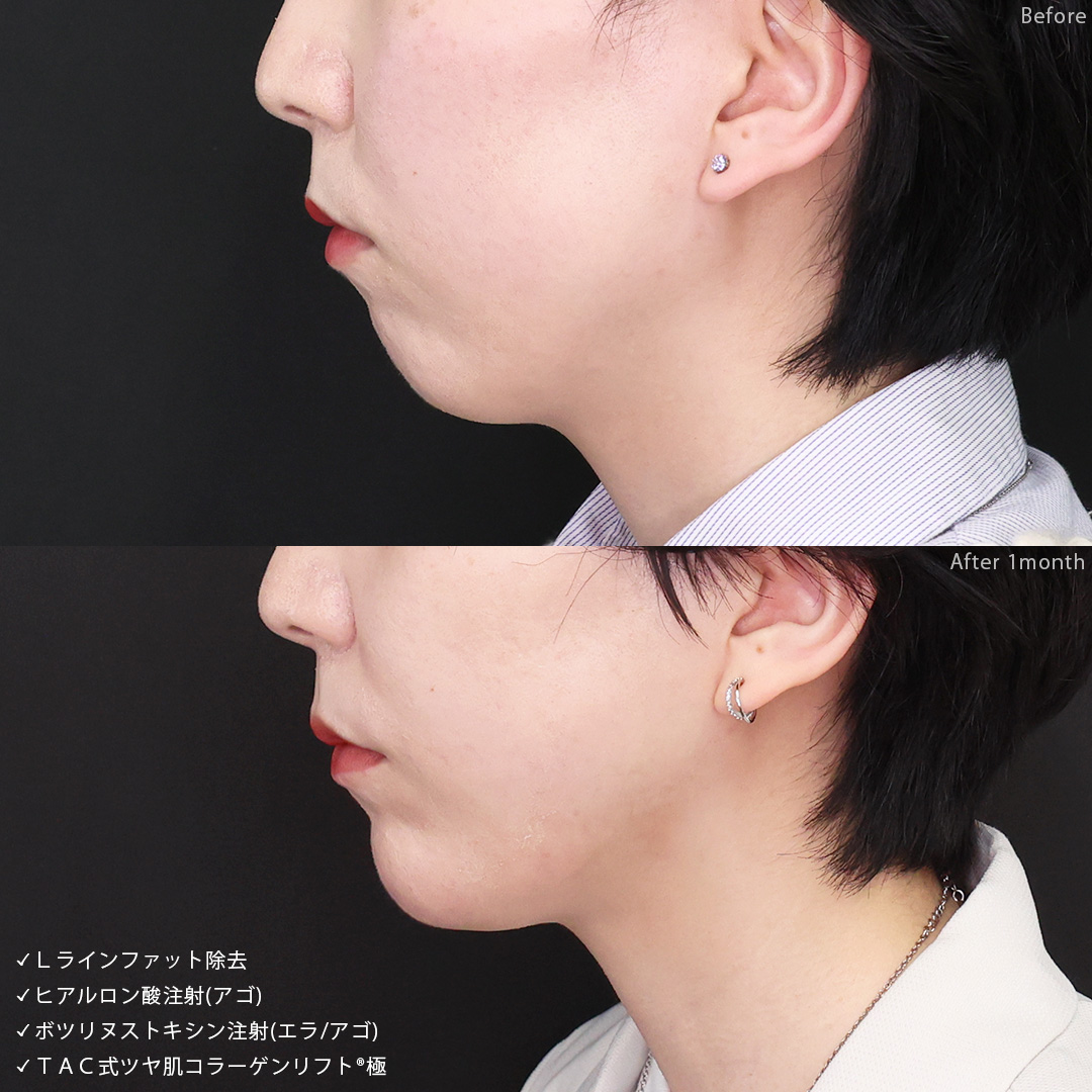小顔整形｜パーフェクトフェイスライン/TAC式 ツヤ肌コラーゲンリフト®/Lラインファット除去（エラ下脂肪除去）の症例写真 施術前後 