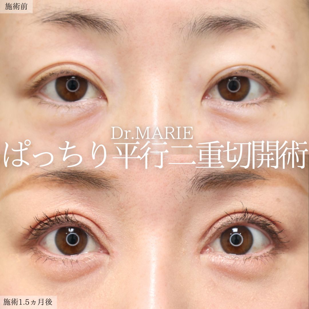 上眼瞼切開術/眼瞼下垂（目つき矯正）/目頭切開術の症例写真 施術前後 