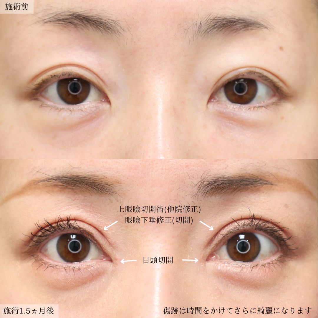 上眼瞼切開術/眼瞼下垂（目つき矯正）/目頭切開術の症例写真 施術前後 
