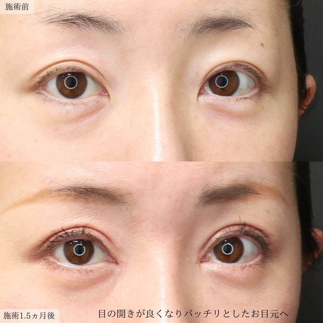 上眼瞼切開術/眼瞼下垂（目つき矯正）/目頭切開術の症例写真 施術前後 