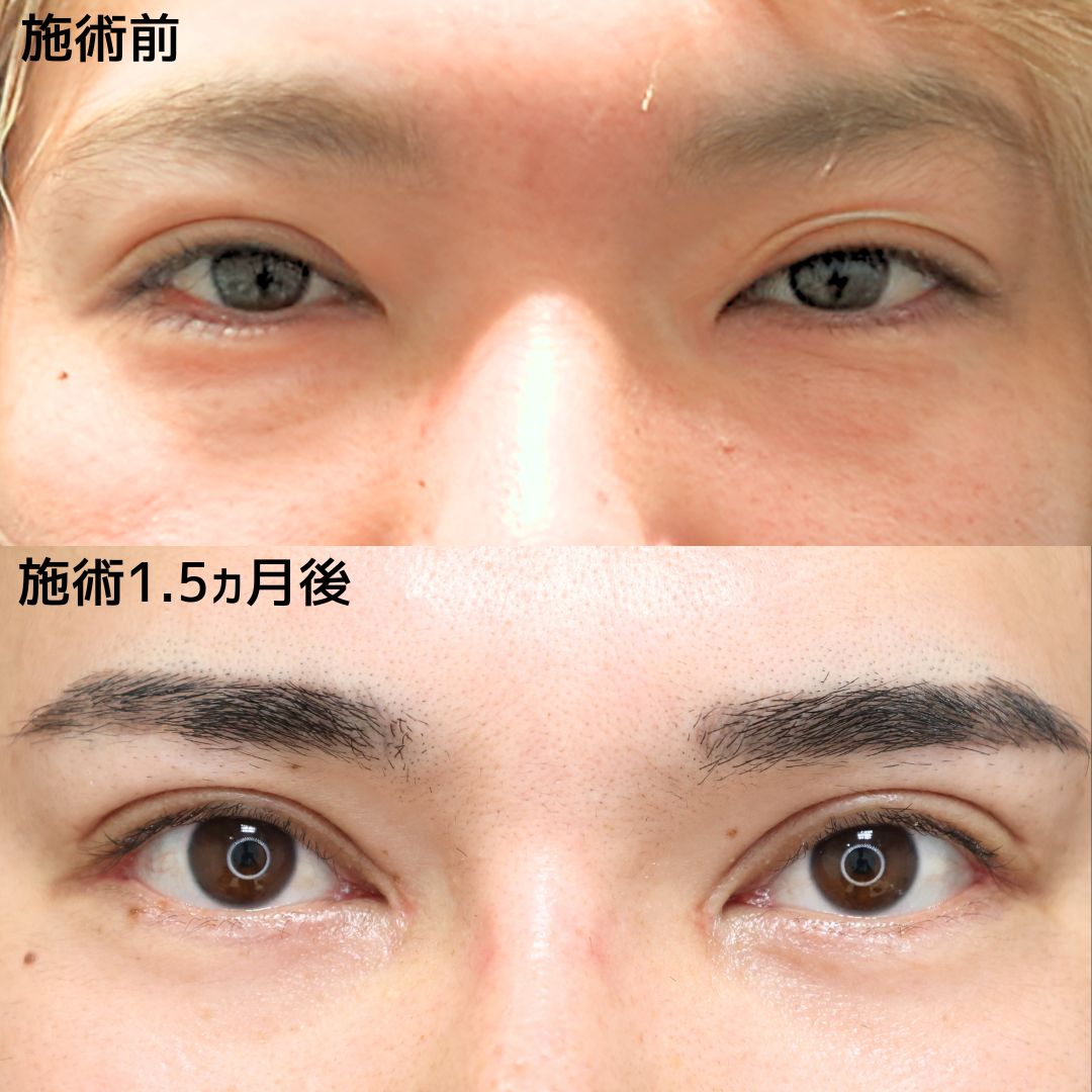 《目元切開》Dr.Marieのイケメン爆誕目元切開術