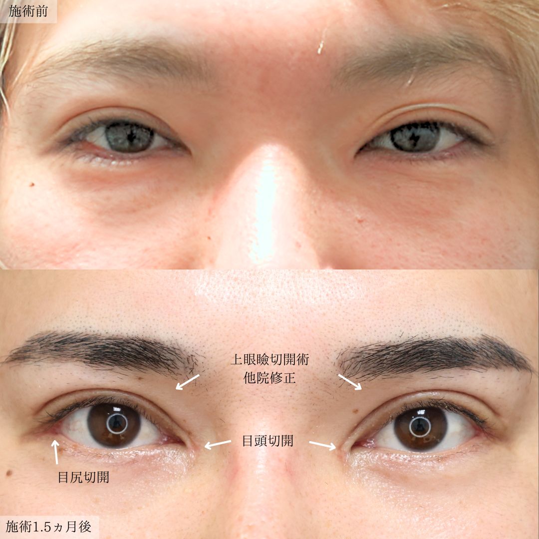 上眼瞼切開術/目頭切開術/目尻切開術の症例写真 施術前後 