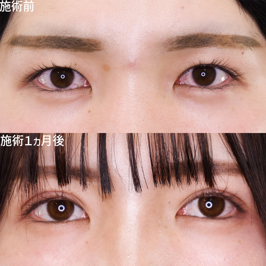 控えめ奥二重からパッチリ平行二重に