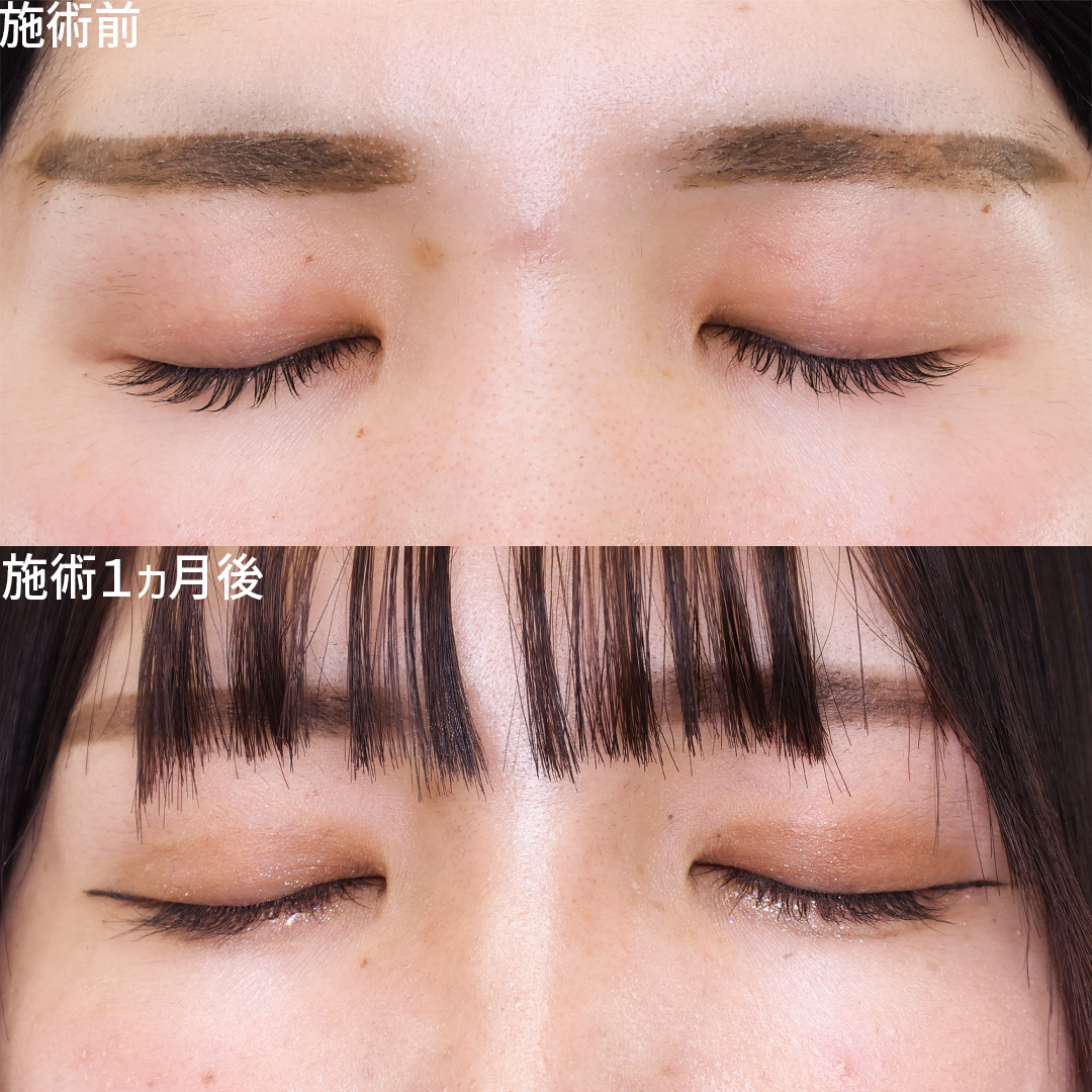 二重埋没法の症例写真 施術前後 