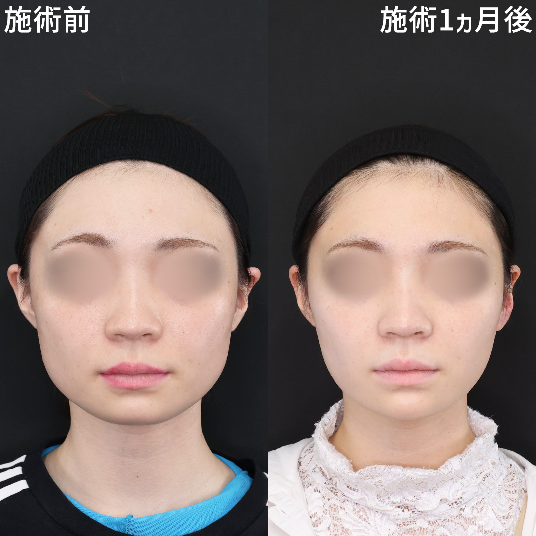 【お顔の余白解消】糸リフト×脂肪除去