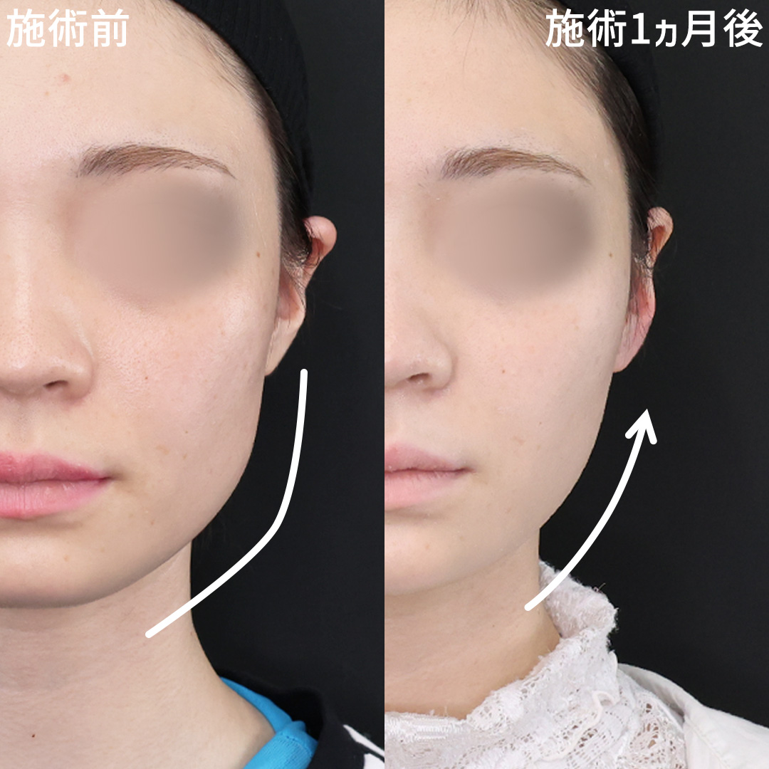 TAC式 ツヤ肌コラーゲンリフト®/ジョールファット除去/Lラインファット除去（エラ下脂肪除去）の症例写真 施術前後 